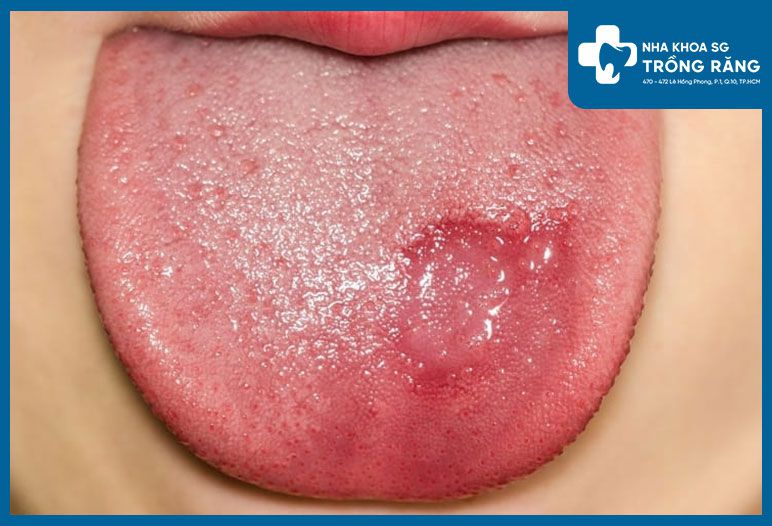 Gai lưỡi bị tổn thương thành một mảng to