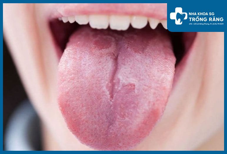 Hình ảnh gai lưỡi bị tổn thương, có màu đậm hơn so với màu sắc thông thường