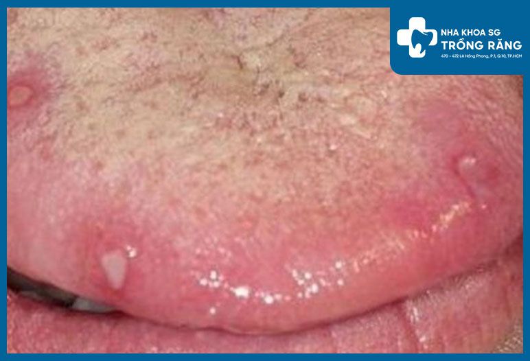Hình ảnh gai lưỡi bị viêm, nổi nhiều hạt ửng đỏ