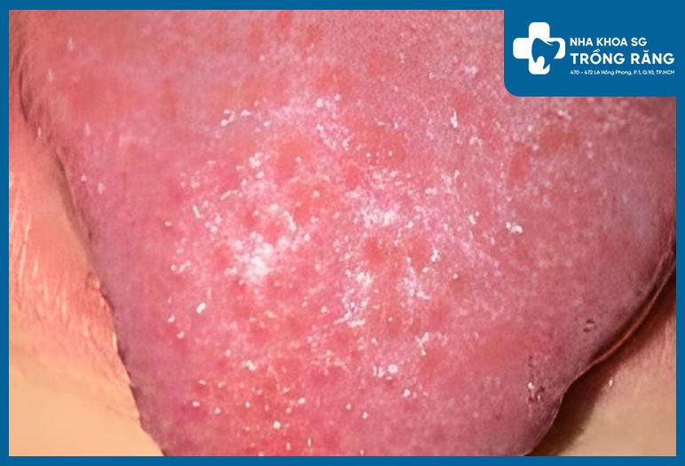 Hình ảnh gai lưỡi bị viêm nổi nhiều hột đỏ