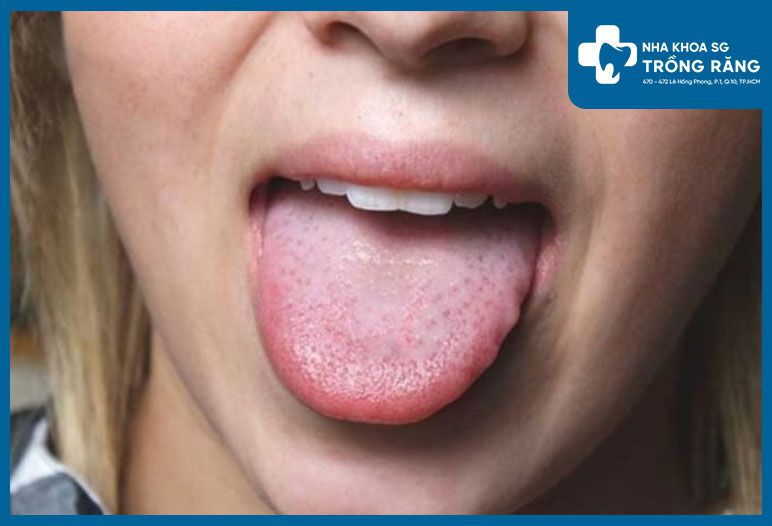 Hình ảnh gai lưỡi xuất hiện nhiều nốt ửng đỏ sưng viêm