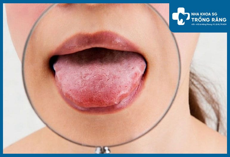 Hình ảnh viêm gai lưỡi thường gặp