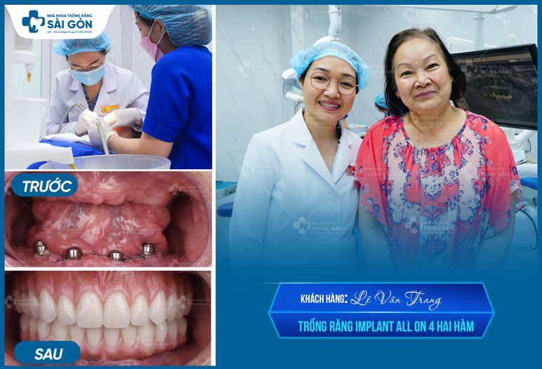 hình ảnh trước và sau khi trồng răng implant