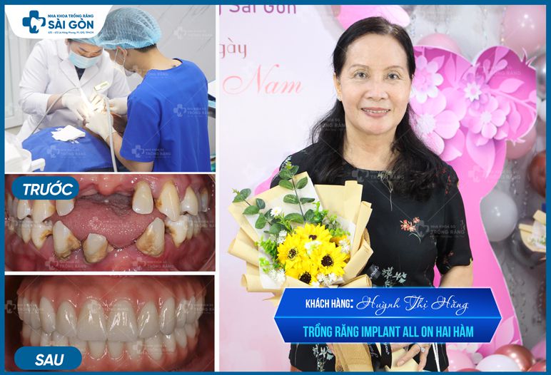 hình ảnh trước và sau khi trồng răng implant