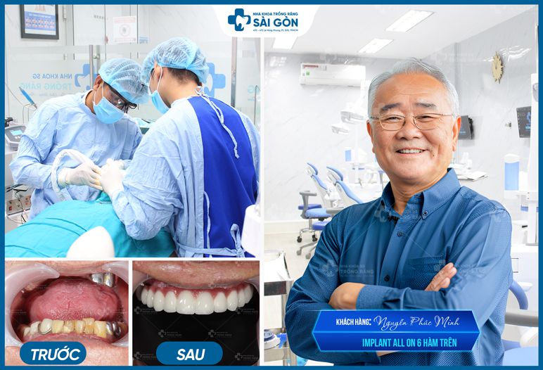 Chú Nguyễn Phúc Minh Trồng Răng Implant All On 6 Hàm Trên.