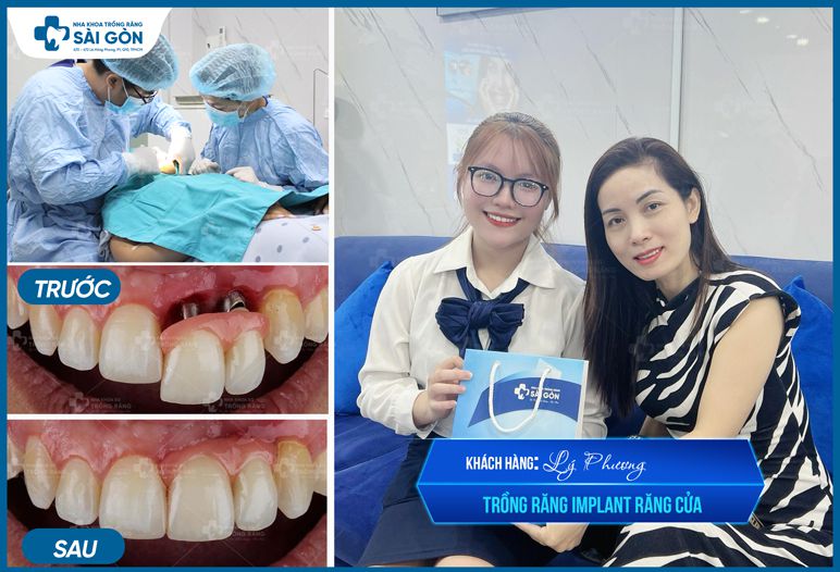 khách hàng trồng răng implant