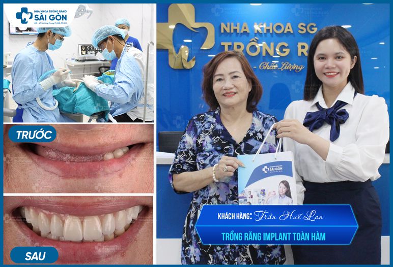 hình ảnh trước và sau khi trồng răng implant