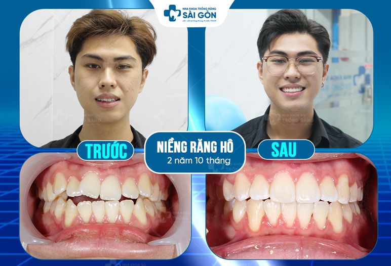 hình ảnh niềng răng hô