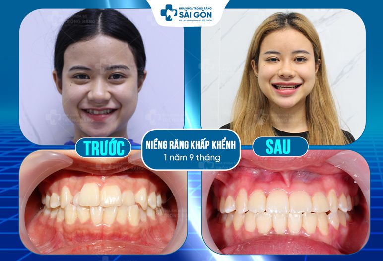 niềng răng khấp khểnh