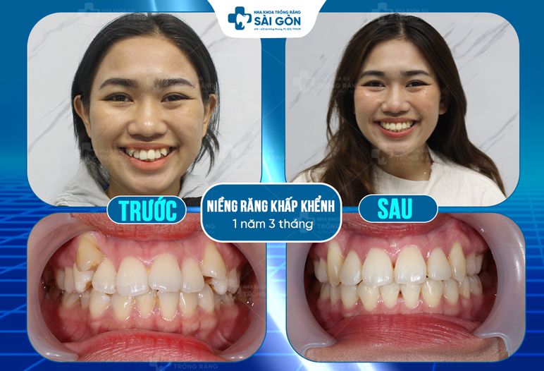 niềng răng khấp khểnh