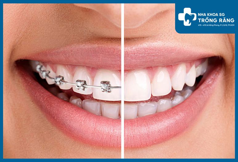 nieng rang tra gop compressed