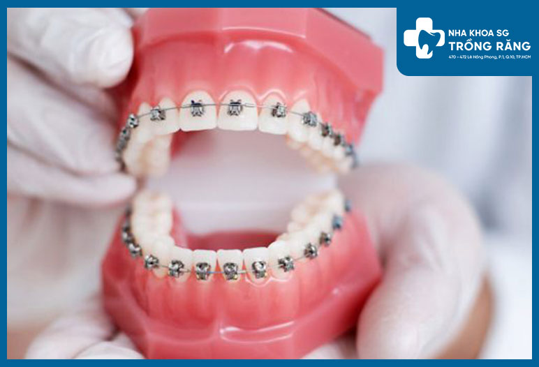 Chỉnh nha niềng răng