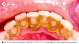 voi rang tu troc thumb compressed