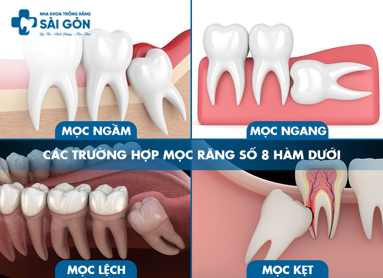 các trường hợp mọc răng số 8
