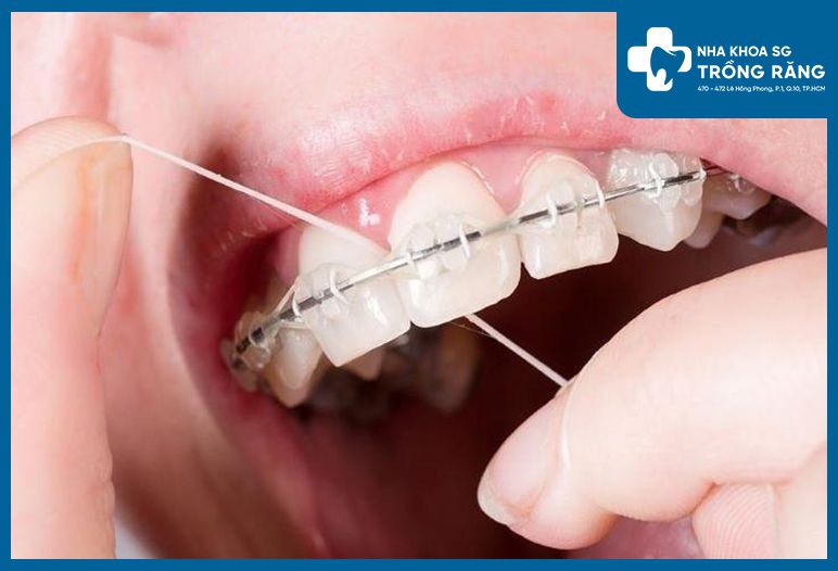 Chỉ nha khoa có tốt cho người niềng răng không?