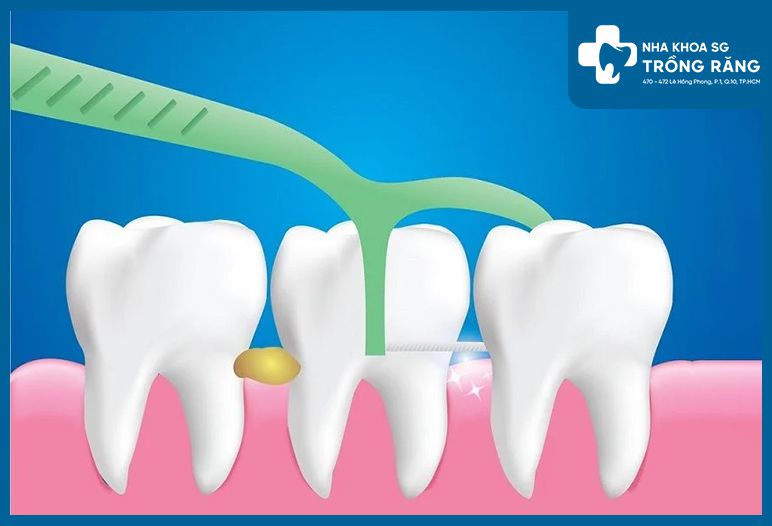 Chỉ nha khoa có hương vị