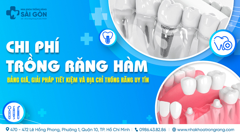 chi phí trồng răng hàm