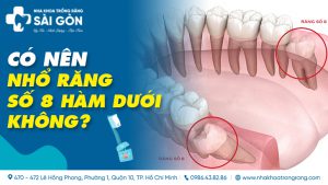 có nên nhổ răng số 8 hàm dưới không