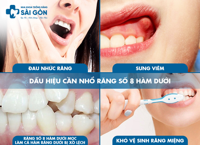 dấu hiệu cần nhổ răng số 8 hàm dưới