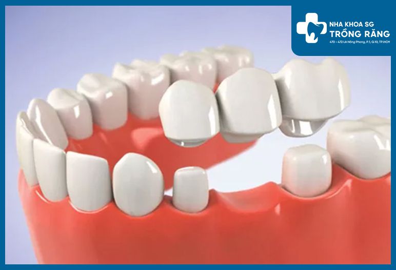 Răng giả tháo lắp