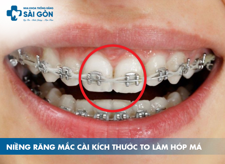 nguyên nhân bị hóp má