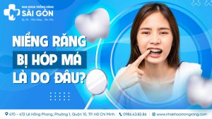niềng răng bị hóp má