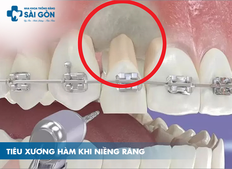 niềng răng bị tiêu xương hàm