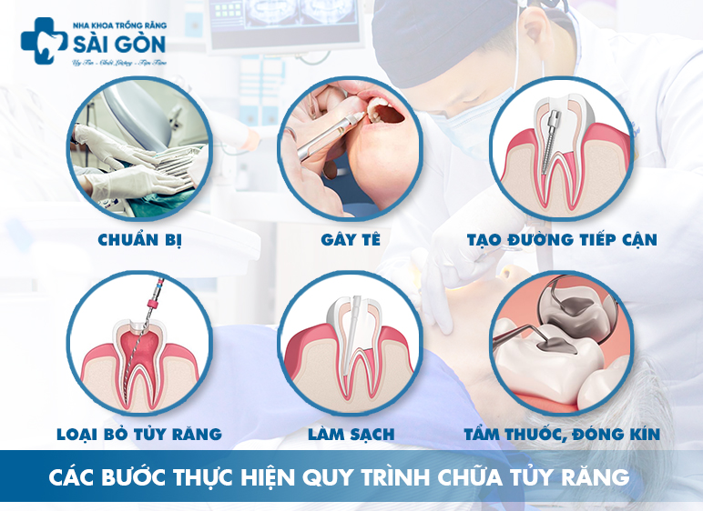quy trình chữa tủy răng không đau