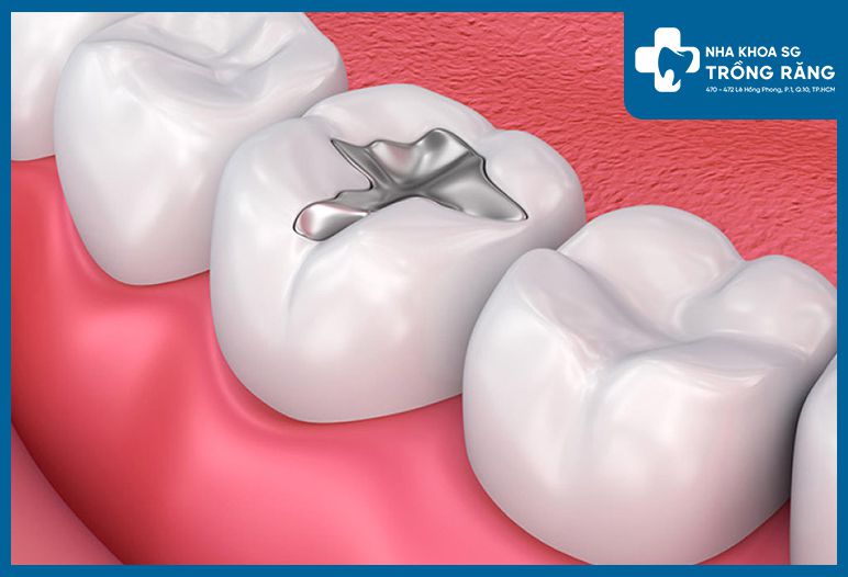 Trám răng bằng Amalgam (hỗn hợp thủy ngân và kim loại)