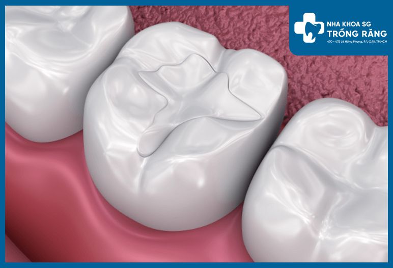 tram rang bang composite resin compressed