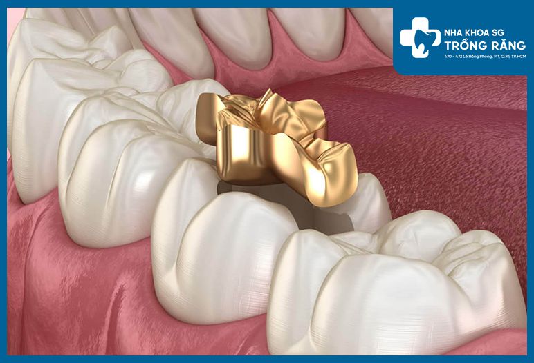 Trám răng bằng vật liệu vàng