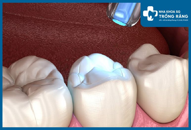 Trám răng giá bao nhiêu tiền? Bảng giá cập nhật mới nhất 2024