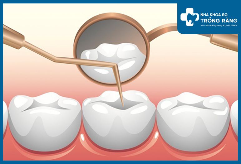 tram rang gia bao nhieu 2 compressed