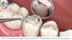 tram rang gia bao nhieu thumbnail compressed