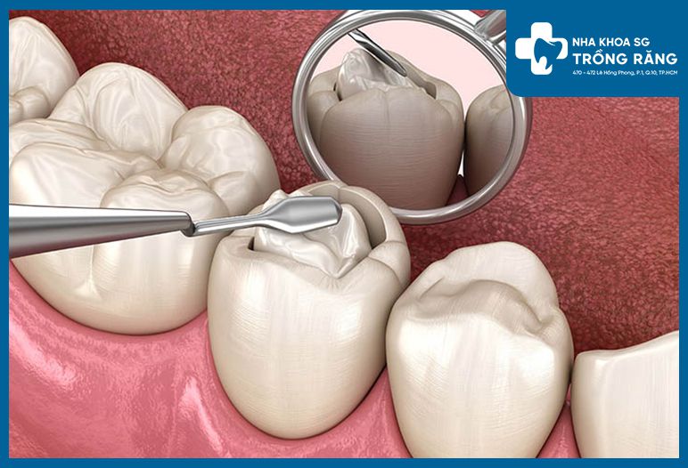 Bảng giá trám răng tại Nha Khoa Trồng Răng Sài Gòn