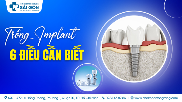 trồng implant 