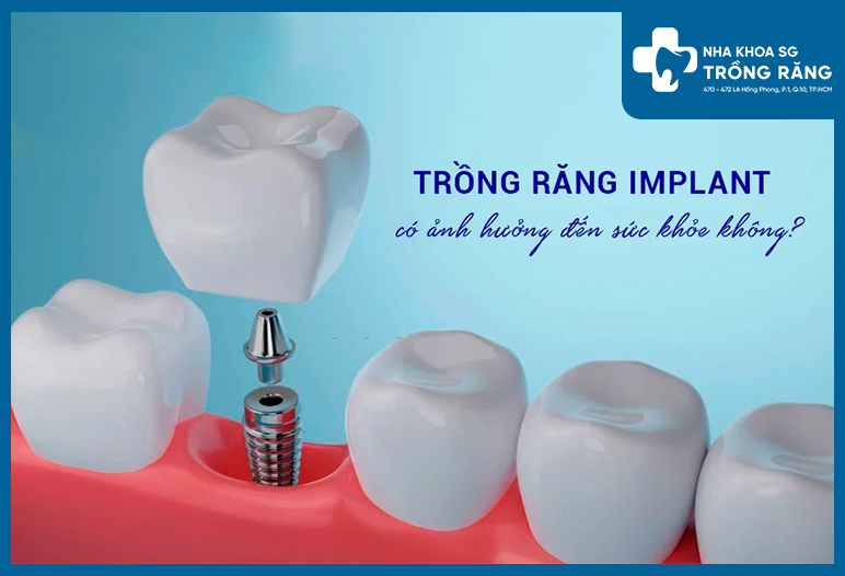 Trồng răng implant có giúp răng chắc và khỏe hơn không?