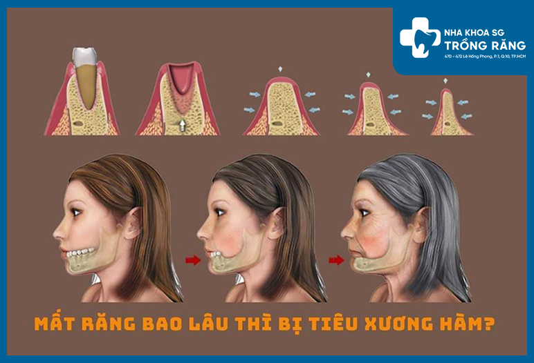 Rang bi tieu xuong 1