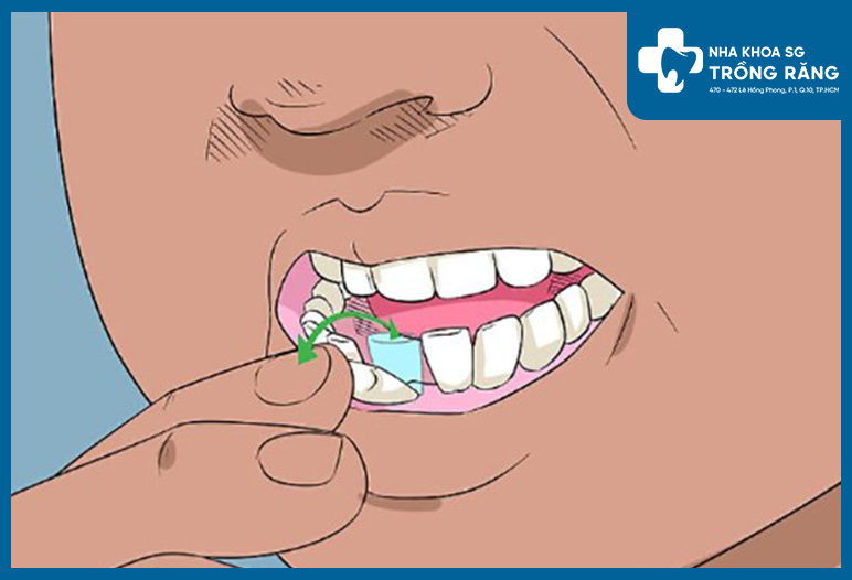 Rang bi tieu xuong 2