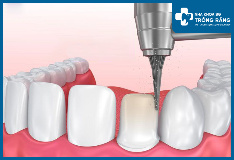 Rang bi tieu xuong 4