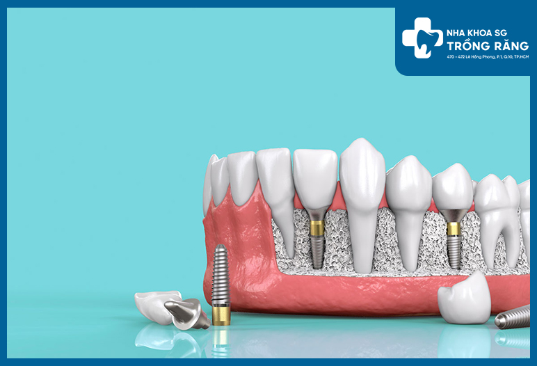 Tim hieu ve qua trinh tich hop xuong tru implant 1