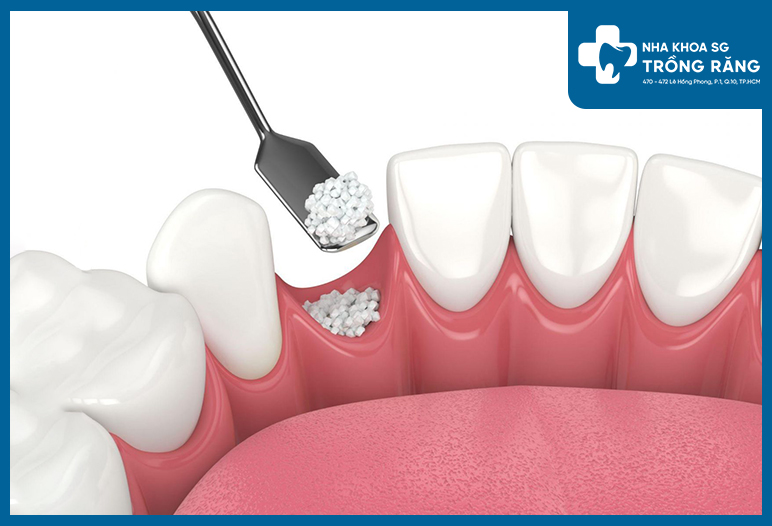 Ghép xương implant là giải pháp hiệu quả để khắc phục tình trạng răng mất xương hàm