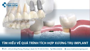 Tim hieu ve qua trinh tich hop xuong tru implant