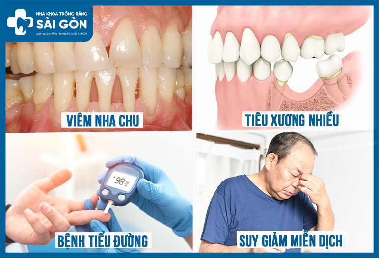 các trường hợp chỉ định trồng implant trì hoãn