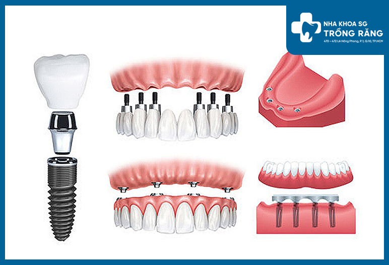 cay ghep implant an toan 1 1