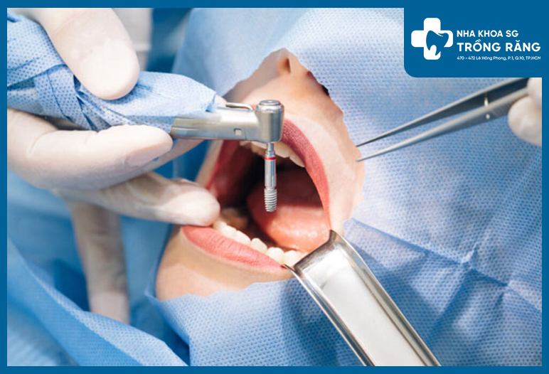 cay ghep implant an toan 2