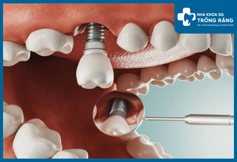 trồng răng implant trì hoãn