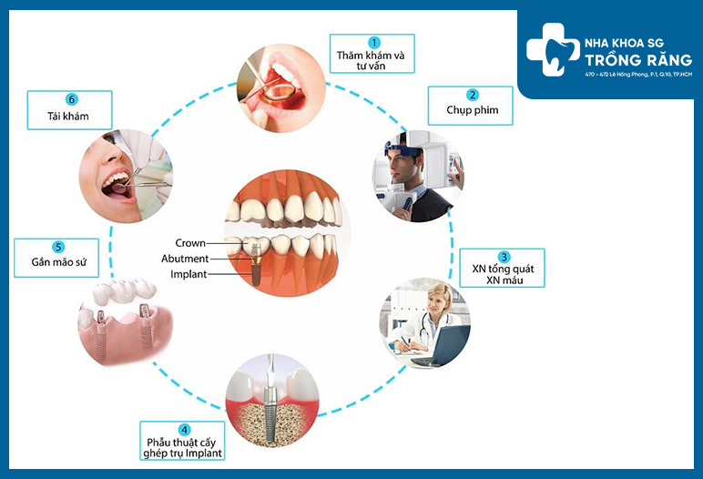 Quy trình tiến hành cấy ghép implant toàn hàm