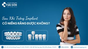 có thể niềng răng sau khi trồng implant không