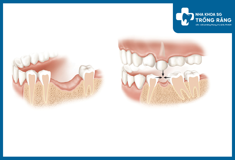 Mật độ và chất lượng xương hàm cần đảm bảo đủ điều kiện để trụ Implant tích hợp và ổn định lâu dài
